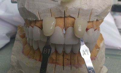 лабораторные этапы как сделать белые зубы А1 и В1 для контраста