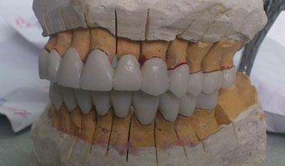 лабораторные этапы как сделать белые зубы