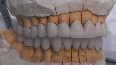 лабораторные этапы как сделать белые зубы