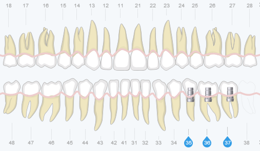 Концевые дефекты зубов лечение