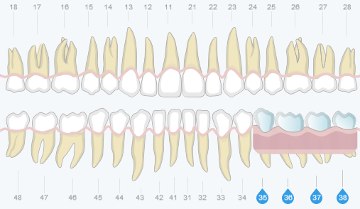 Концевые дефекты зубов лечение