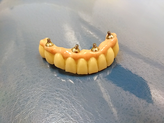 Десять зубов на четырех имплантах