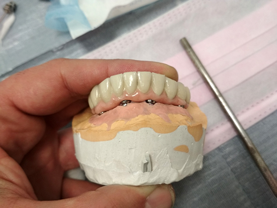Десять зубов на четырех имплантах