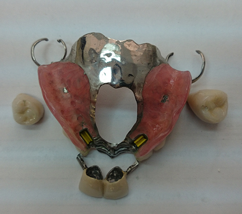 бюгеля c аттачменами на четырех зубах