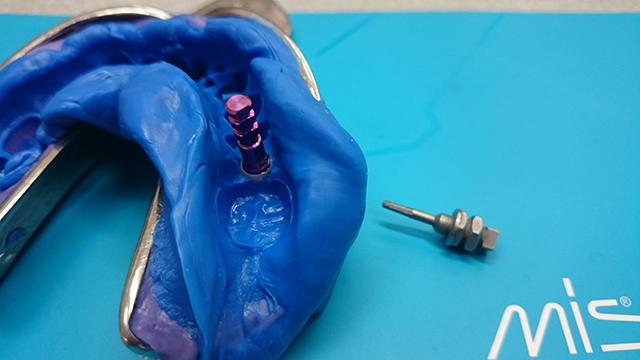 Implant MIS C1 лабораторные этапы изготовления протеза