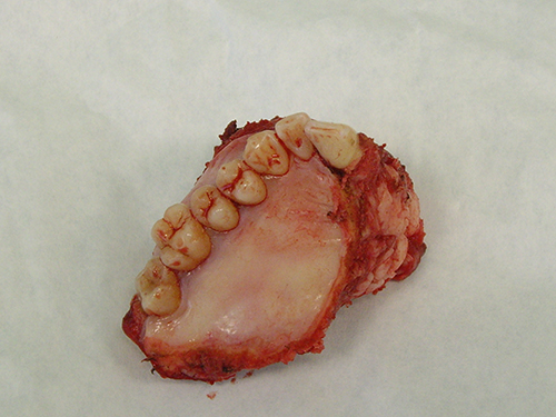 фрагмент верхней челюсти с раковой опухолью