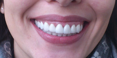 как сделать белые зубы